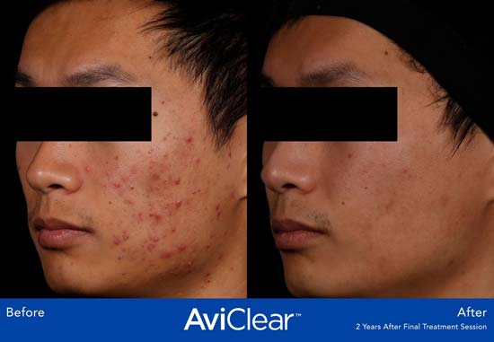 AviClear Before and After Asian Male Face
