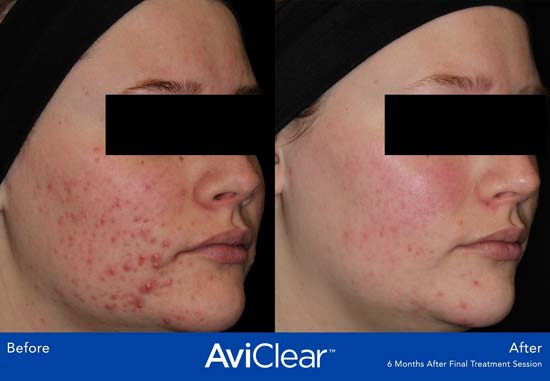 AviClear Before and After Woamn's Face