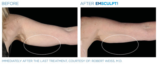Emsculpt NEO Before and After Triceps