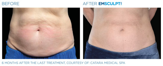 Emsculpt NEO Before and After Tummy Front