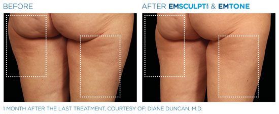 Emsculpt NEO Before and After Buttocks