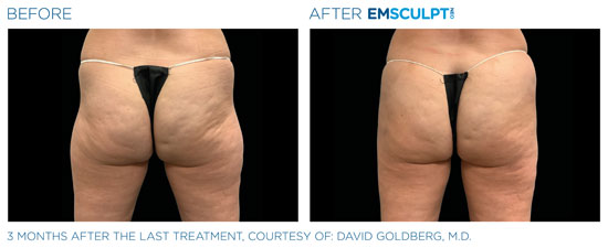Emsculpt NEO Before and After Buttocks