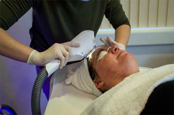 The IPL Laser Facial treatment