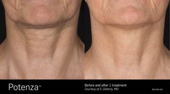 Potenza Before and After Neck