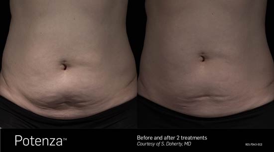 Potenza Before and After Belly