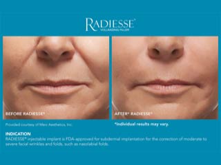 Radiesse® Before and After
