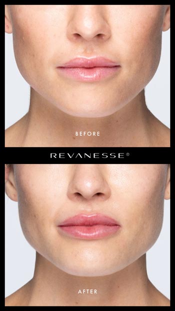 Revanesse® Before and After  Woman's Lips