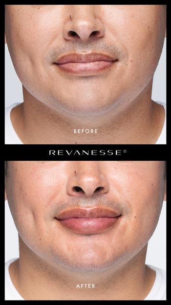 Revanesse® Before and After Man's Lips