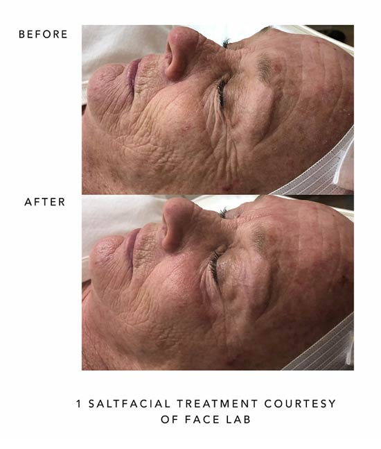Salt Facial Before and After Older Woman's Face