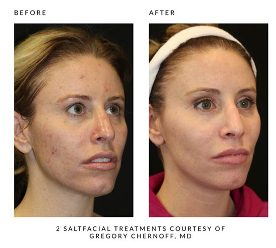 Salt Facial Before and After Younger Woman's Face