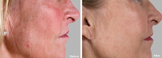 Stem Cell Facial  Before and After Woman's Cheek
