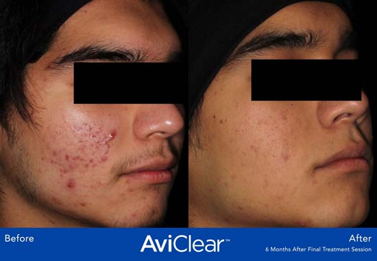 AviClear Before and After Man's Face