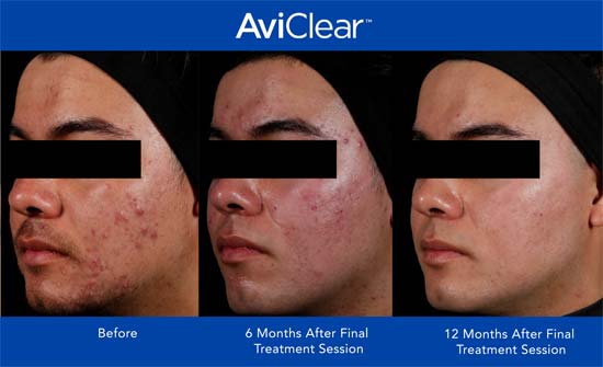 AviClear Before and After Male Face