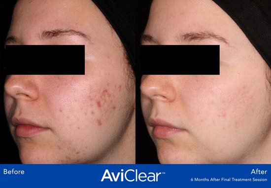 AviClear Before and After Teen Girl Face