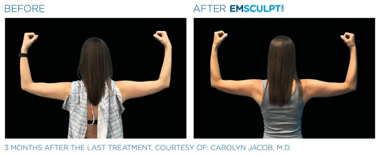 Emsculpt NEO Before and After Arms