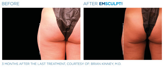 Emsculpt NEO Before and After Thighs and Hips