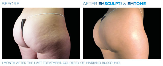 Emsculpt NEO Before and After Thighs and Hips Side