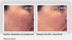 Hero Peel before and after image at Henderson MedSpa