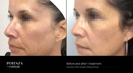 Potenza Before and After Woman's Face