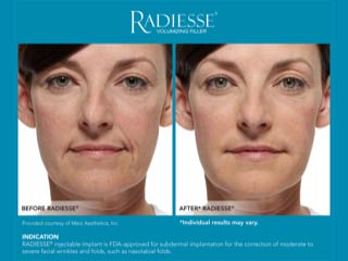 Radiesse® Before and After