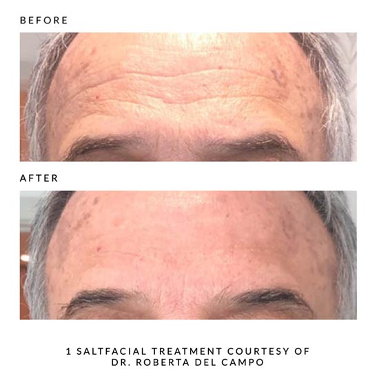 Salt Facial Before and After Man's Forehead