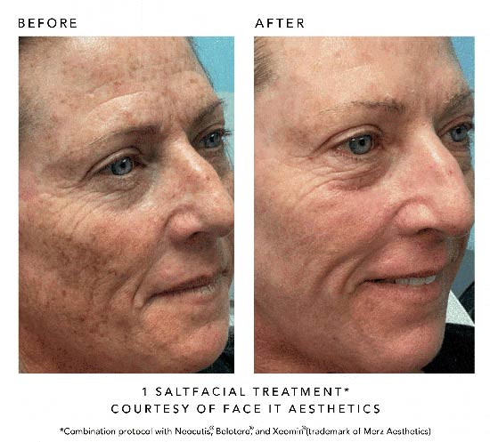 Salt Facial Before and After Middle Aged Woman's Face