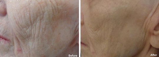 Stem Cell Facial Before and After Woman's Cheek
