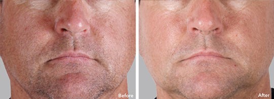 Stem Cell Facial  Before and After Man's Face