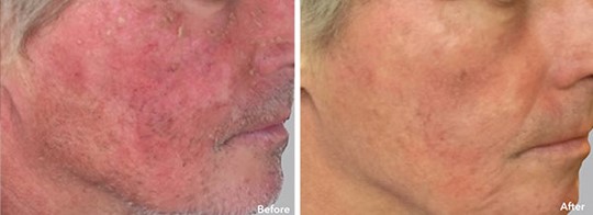 Stem Cell Facial  Before and After Man's Cheek