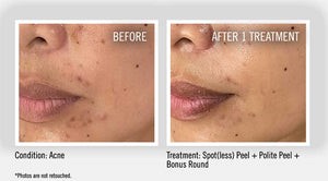 Spotless Peel before and after image at Henderson MedSpa