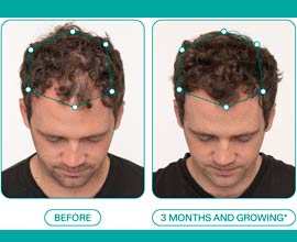 Nutrafol Hair Growth provided by Henderson Med Spa
